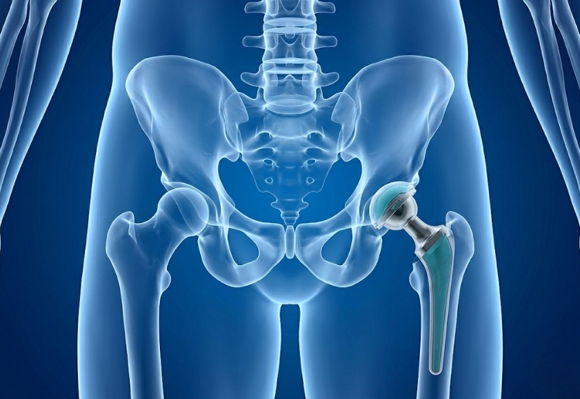 Knee Replacement Surgery